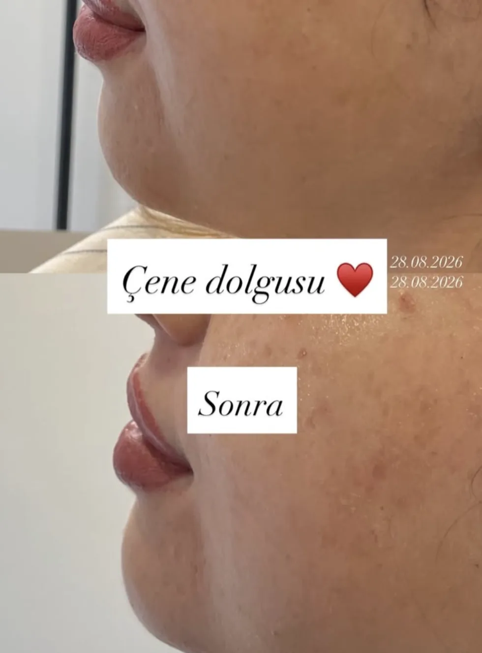 Çene dolgusu öncesi ve sonrası, Alt yüz oranını dengeleme