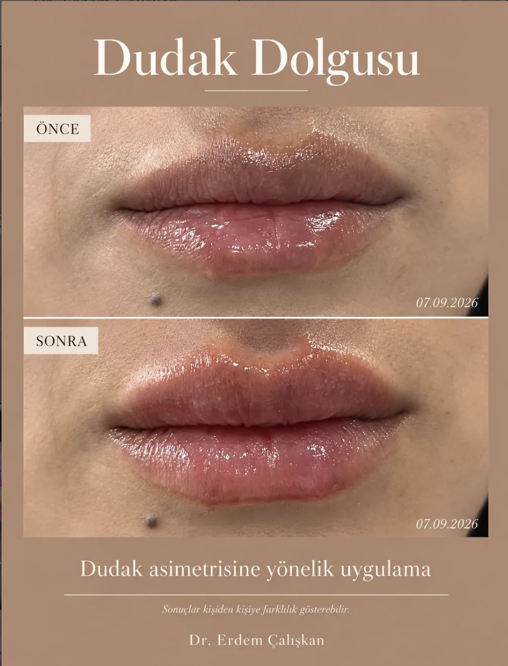 Dudak asimetrisine yönelik dolgu öncesi ve sonrası, 7 Eylül 2026