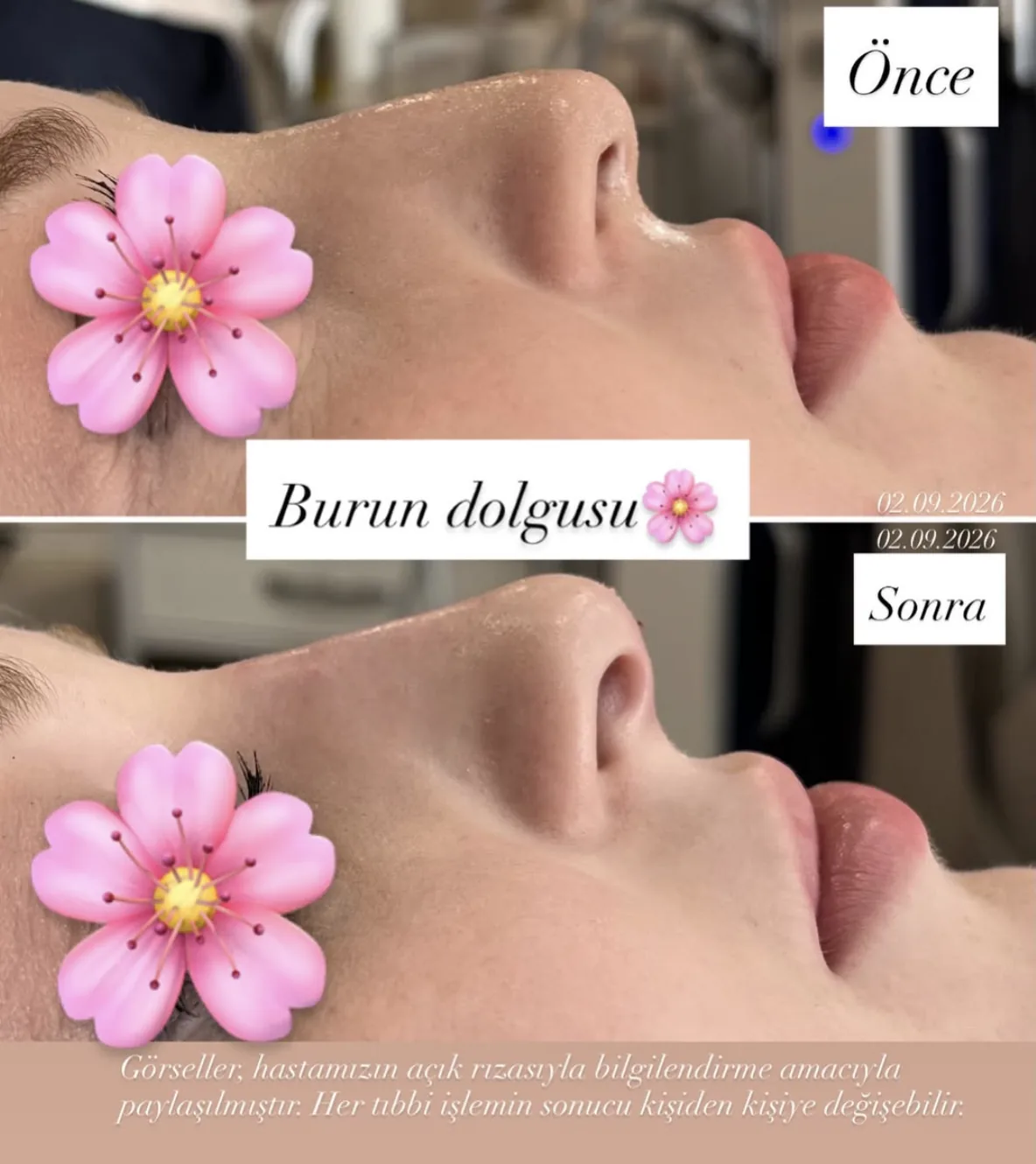 Burun dolgusu öncesi ve sonrası sonucu