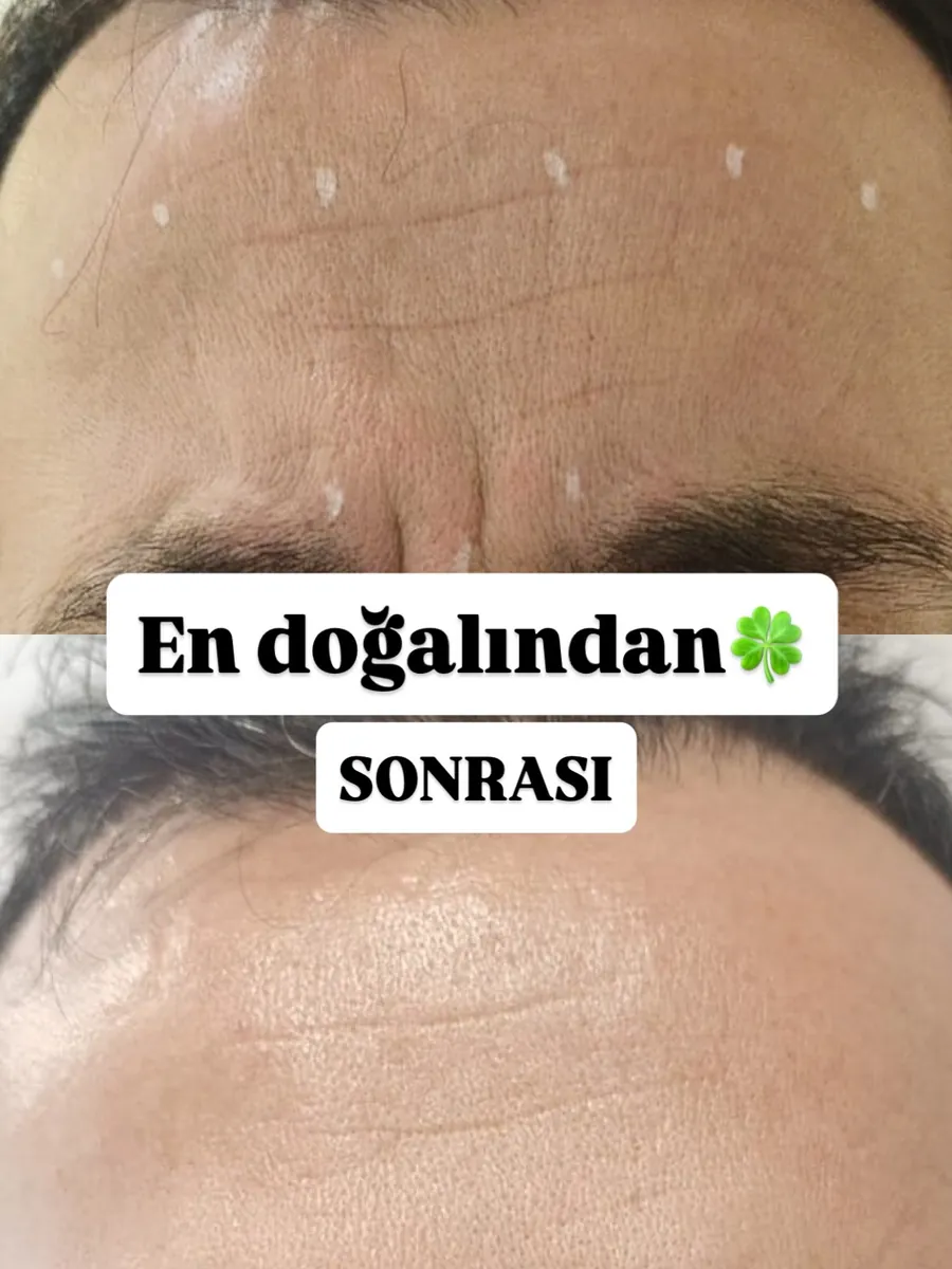 Alın çizgilerine botoks öncesi ve sonrası