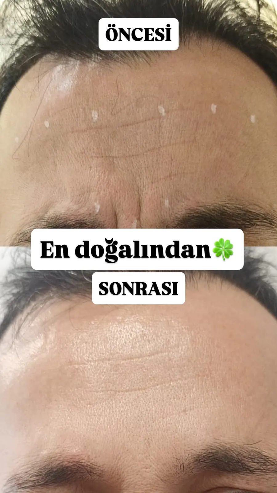 Alın çizgileri öncesi ve sonrası, öncesi / sonrası