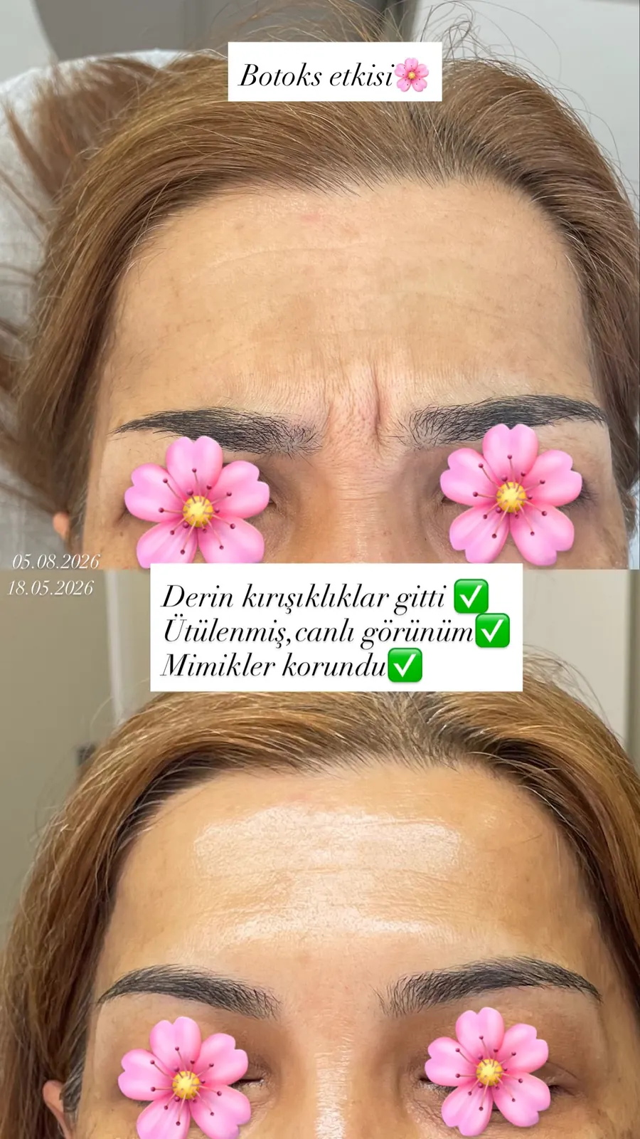 Alın ve kaş arası öncesi ve sonrası, öncesi / sonrası