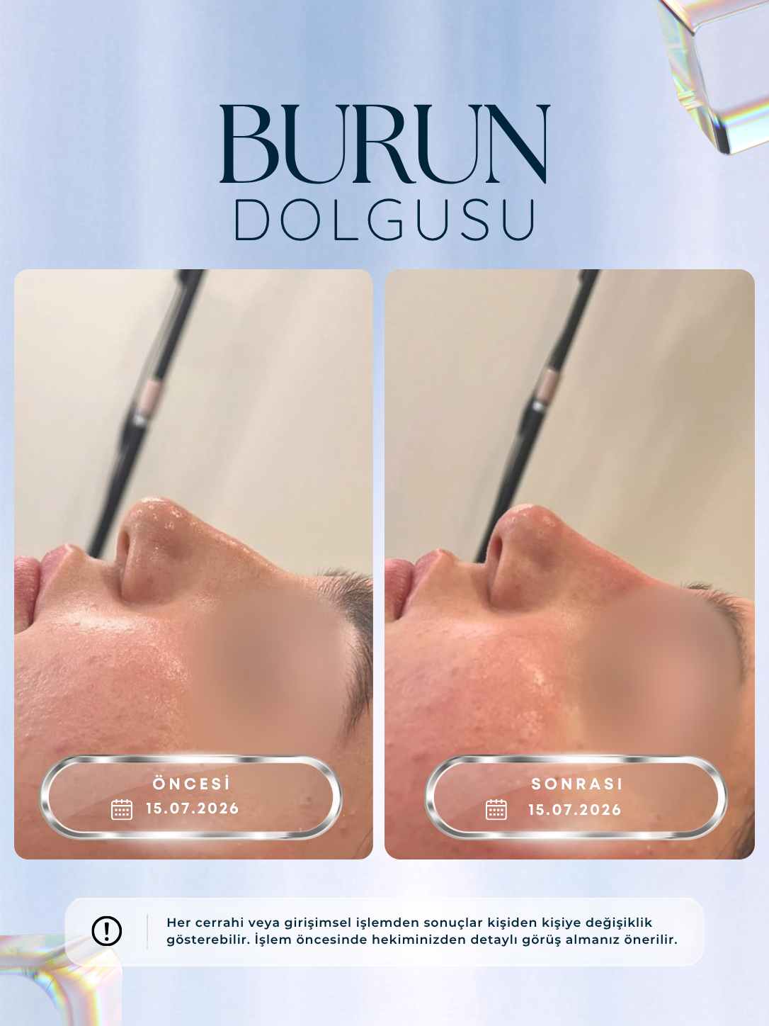Burun dolgusu profil öncesi ve sonrası sonucu