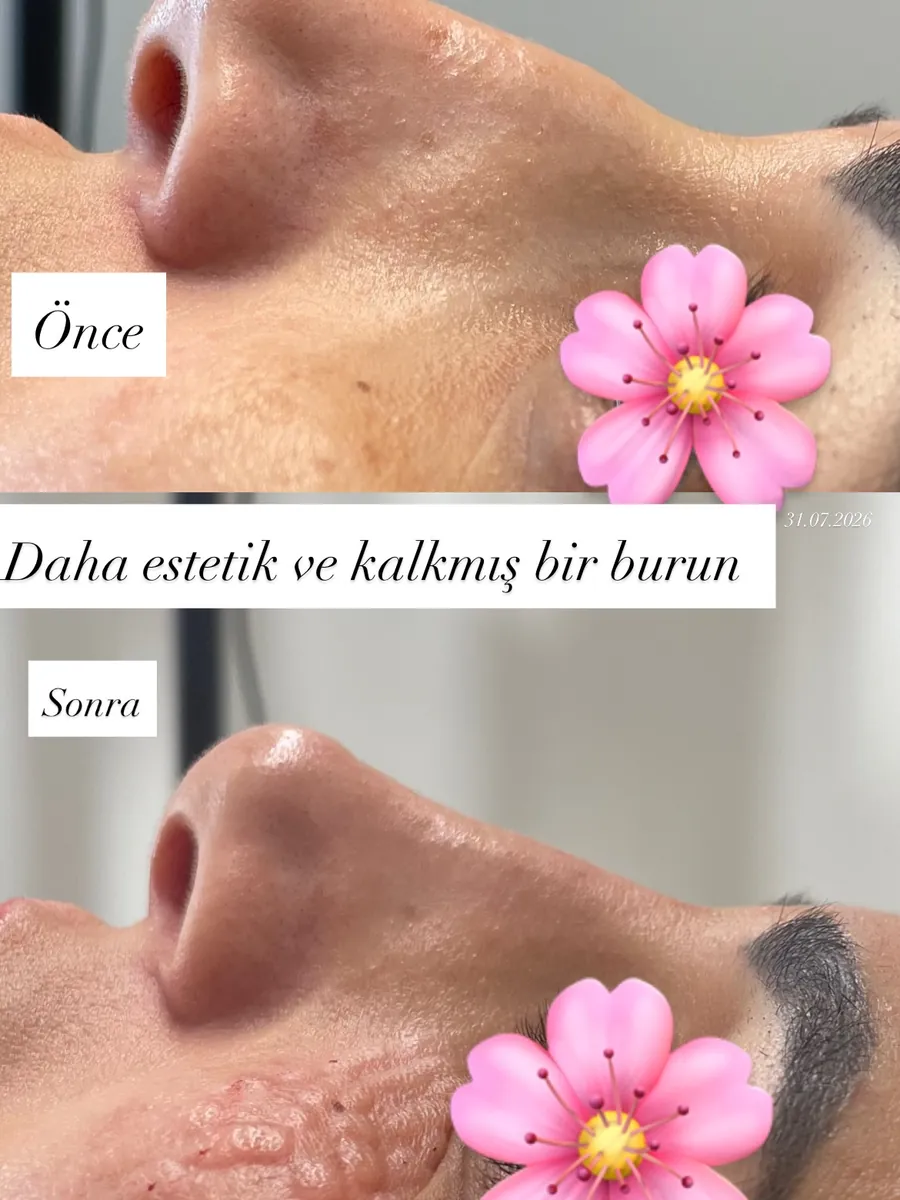 Burun dolgusu öncesi ve sonrası, Kemerli ve düşük burun ucu · 31 Temmuz 2026