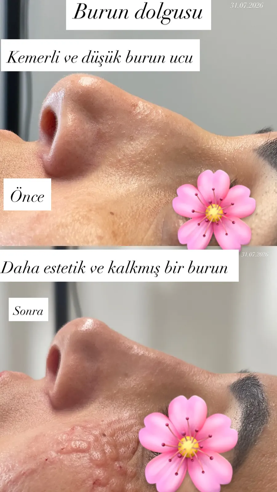 Burun dolgusu öncesi ve sonrası, 31 Temmuz 2026