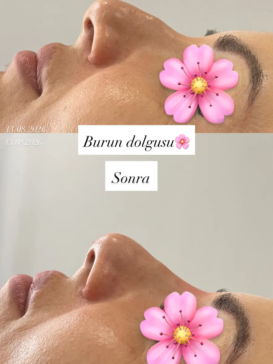 Burun dolgusu öncesi ve sonrası, Profil dengesi · öncesi / sonrası