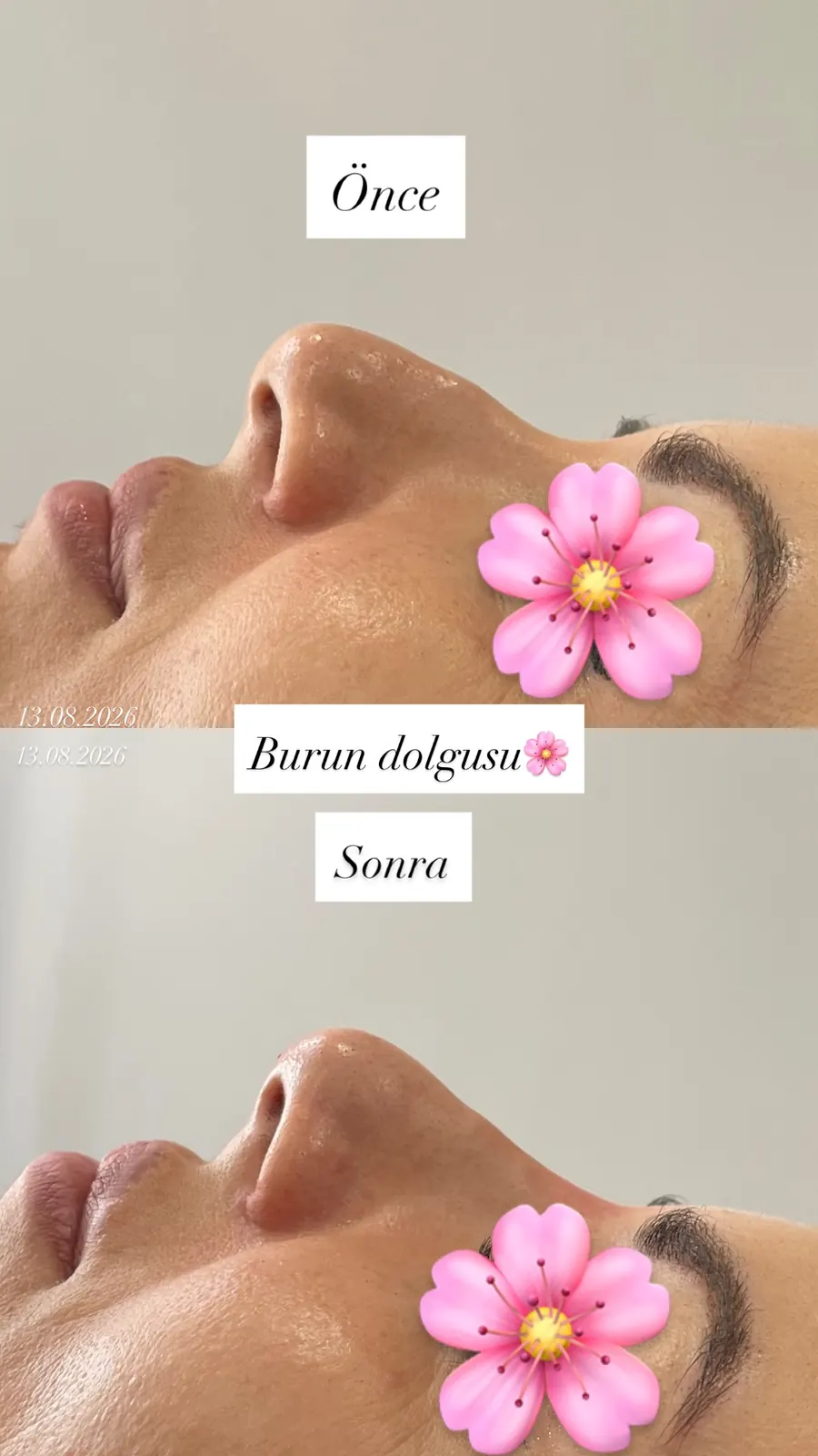 Burun dolgusu öncesi ve sonrası, öncesi / sonrası