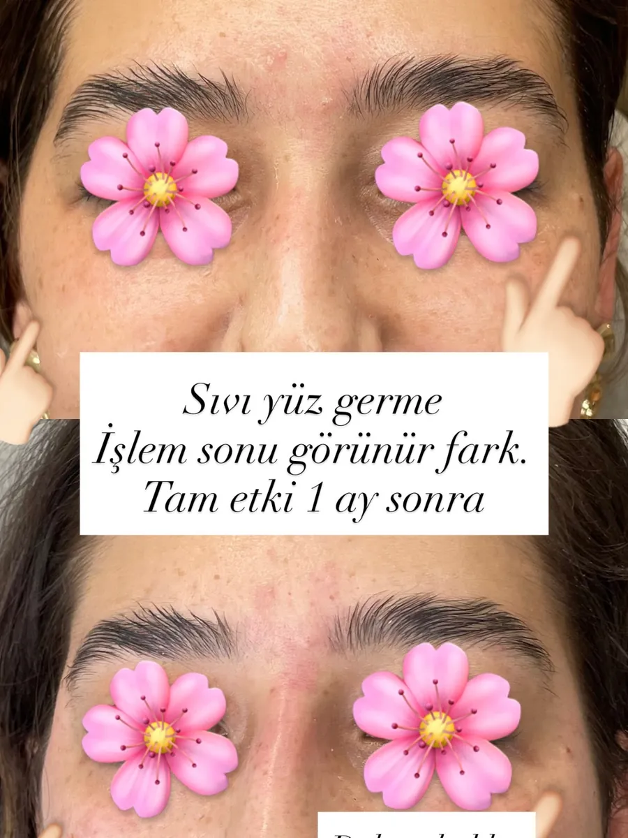 Şakak dolgusu öncesi ve sonrası, Sıvı yüz germe · öncesi / sonrası