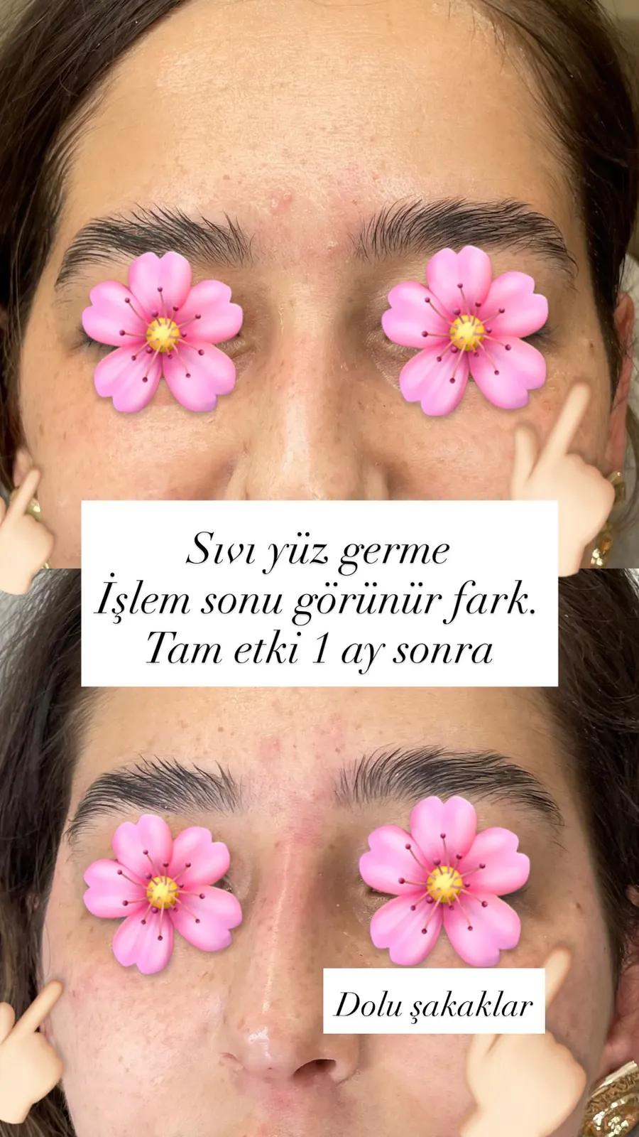 Şakak dolgusu öncesi ve sonrası, öncesi / sonrası