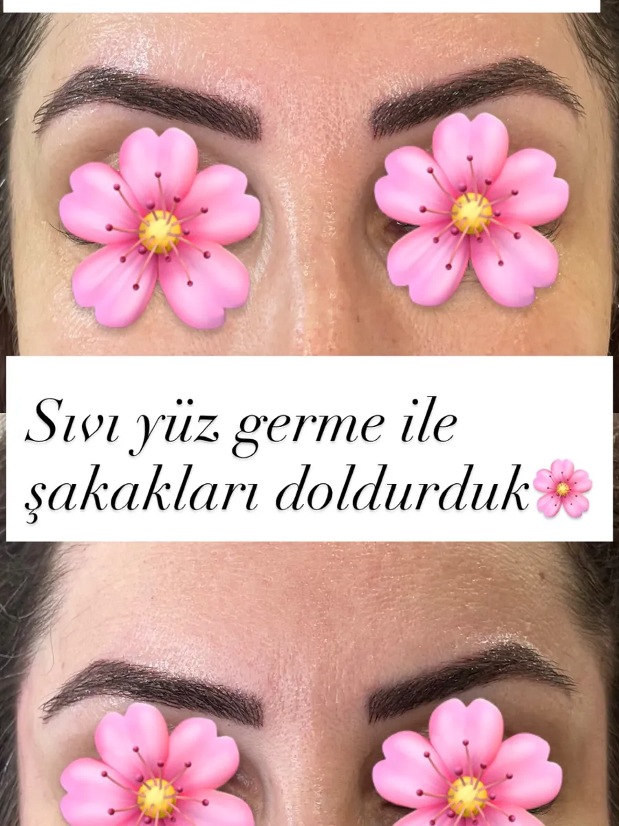Şakak dolgusu öncesi ve sonrası, Sıvı yüz germe · öncesi / sonrası