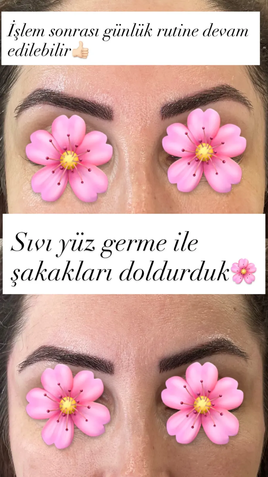 Şakak dolgusu öncesi ve sonrası, öncesi / sonrası